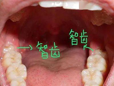 拔智齿后半个月牙龈肿胀的原因及应对方法——澳门专家解析