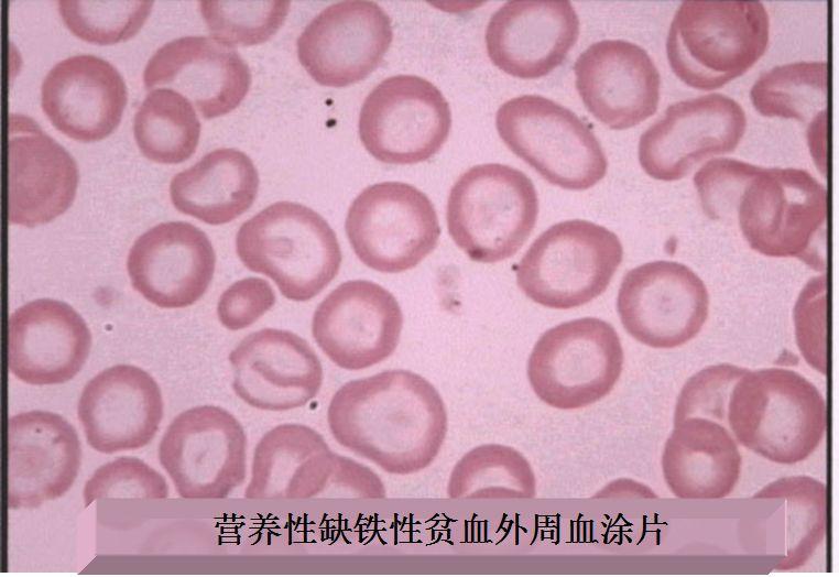 缺铁性贫血的补铁治疗，疗程与注意事项