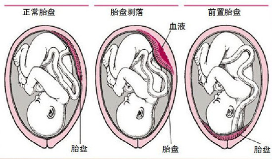 怀孕三个月胎盘前置现象解析