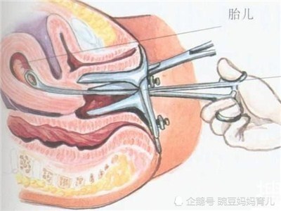 六个月引产需要清宫吗？深入了解引产与清宫的关联